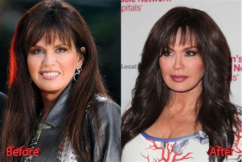 marie osmond boobs|Marie Osmond Plastic Surgery: Marie’s Youthful Looks